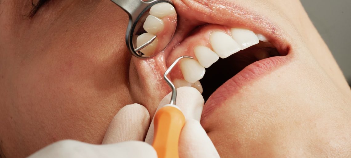 Tips And Strategies For Reducing The Cost Of Dental Treatment